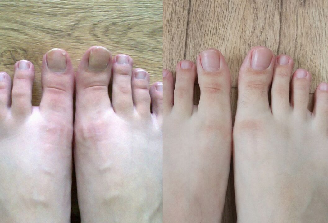 Vor und nach der Behandlung versprach Pilgus Creme