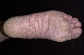 Anzeichen und Symptome von Beinen in den Beinen