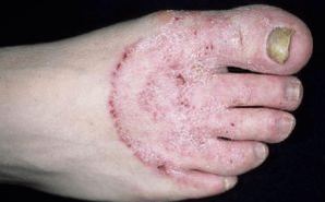 Die Gründe für das Aussehen des Pilzes in den Beinen