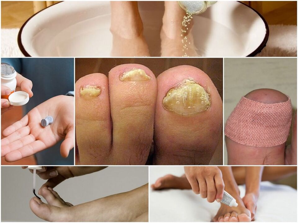 Nagelpilzbehandlung