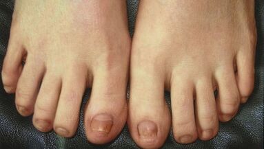 Stadien der Nagelpilzentwicklung