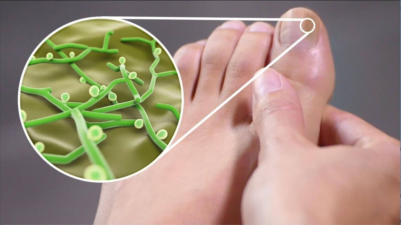 Erreger von Zehennagelpilz