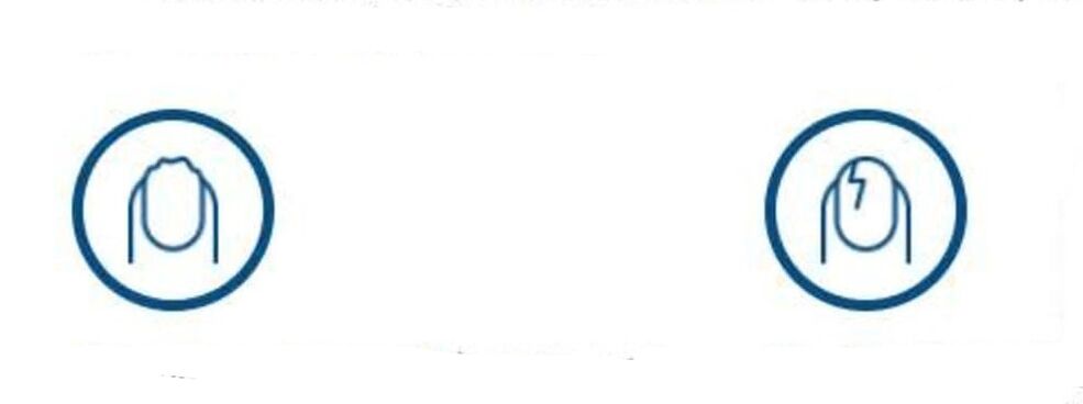 Nagelverformung aufgrund einer Pilzinfektion